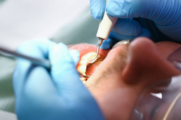 Best Emergency Tooth Extraction in Berea, KY