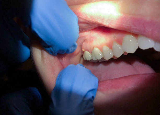 Best Emergency Denture Repair in Berea, KY