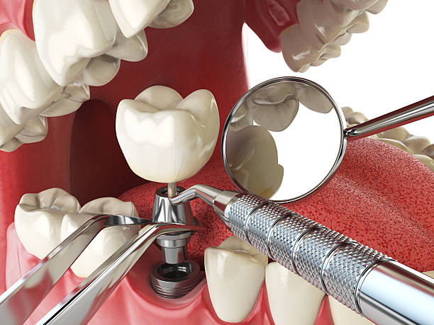 Best Emergency Root Canal Treatment in Berea, KY