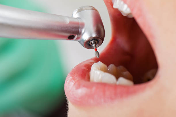 Best Emergency Treatment for Dental Infections or Abscesses in Berea, KY